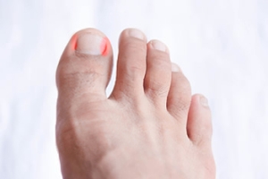 Ingrown Toenails and Other Common Toenail Conditions