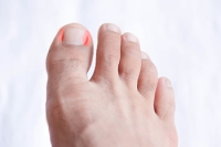 Ingrown Toenails and Other Common Toenail Conditions