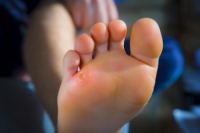 Definition and Symptoms of Corns
