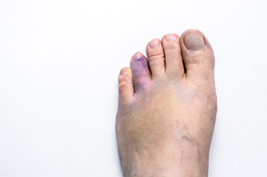 Causes of a Broken Toe and When to See a Podiatrist