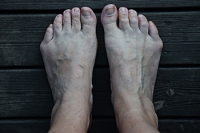 What is a Tailor’s Bunion?