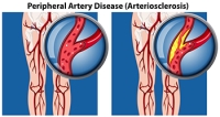 Managing Peripheral Artery Disease