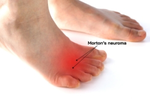 Treatment Methods for Morton&#039;s Neuroma