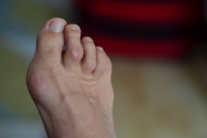 Understanding Hammertoes