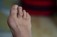 Understanding Hammertoes