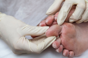 How Podiatrists Help With Diabetic Foot Care