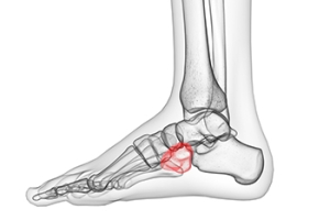 Cuboid Syndrome and Its Treatment