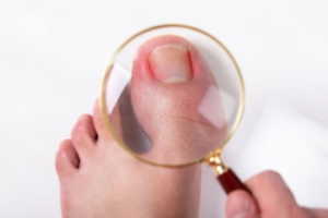 Treatment Options for Ingrown Toenails