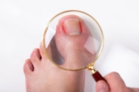 Treatment Options for Ingrown Toenails