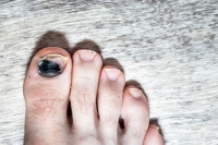 Causes of a Bruised Toenail